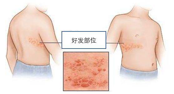 带状疱疹后两个月癌，警惕潜在风险与早期识别