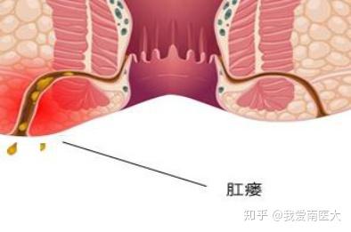 肛瘘手术后的第一个月，恢复与后续护理