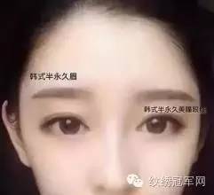 眉毛种植六个月后惊人效果图，重塑自信眉部轮廓